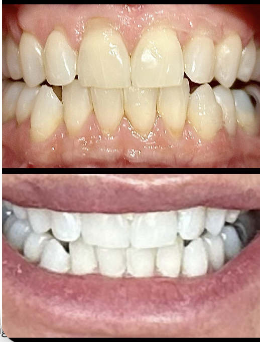Before and after professional teeth whitening result 4 — Carte Blanche Los Angeles client